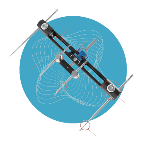 Sistema de Transporte Óseo Transversal Wishbone