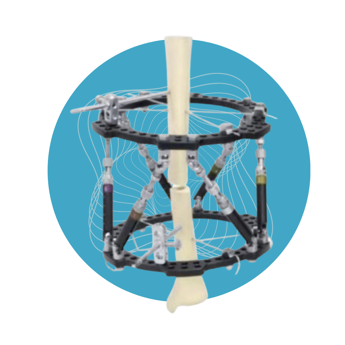 Marco de Fijación Externa Digital Hexápodo