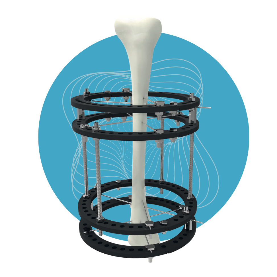 EF-18 - Set de Fijador Circular