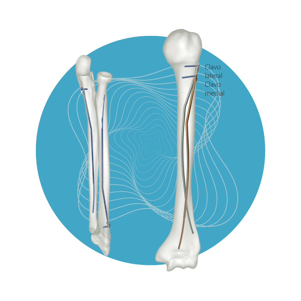 NL-08 - Set L-TEP 2.0-3.5mm
