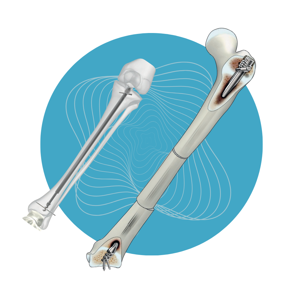 NL-19 - Set de Clavo Telescópico D-Scope