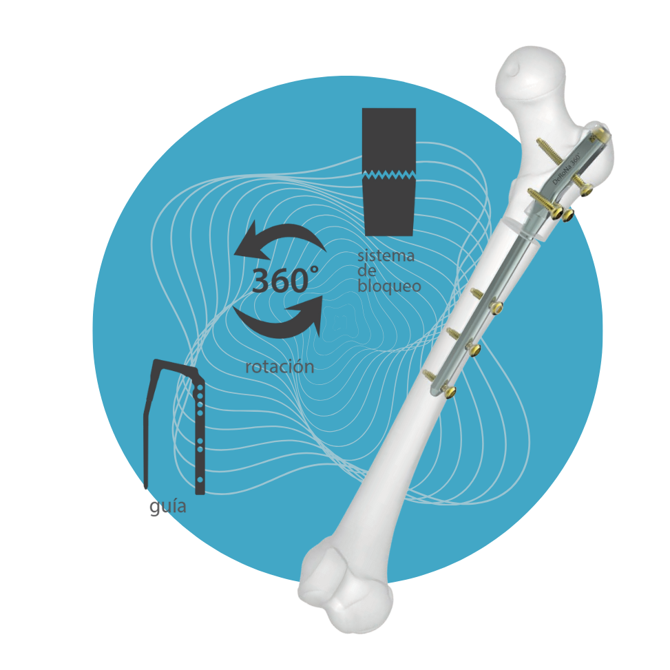 PD-09 - Set de Clavo DeRoNa 360°