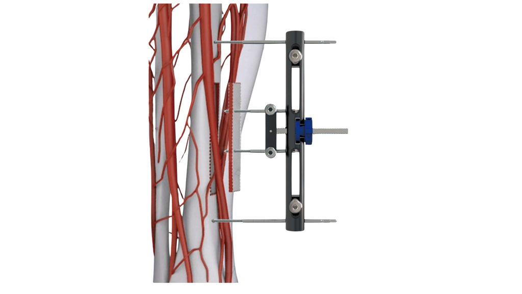 Sistema TTT – Transporte Óseo Transversal de la Tibial