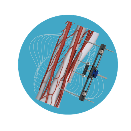 Sistema TTT – Transporte Óseo Transversal de la Tibial